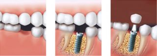 dental implantology courses kualalumpur Malaysia Cosmetic Dentist