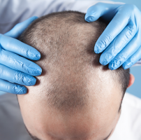 clinics hair transplant clinics kualalumpur Hair Transplant Centre Malaysia - Global Health Asia Pacific Award Winner Best Hair Transplant Clinic 2020 . Highest Authority in Hair Restoration