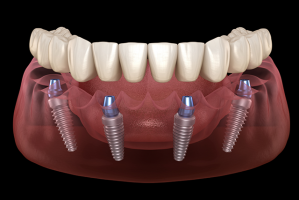 dental implantology courses kualalumpur Dental Implant KL Clinic
